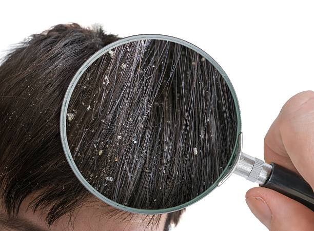 6 نصائح لحماية فروة الرأس من الجفاف والقشرة فى الشتاء